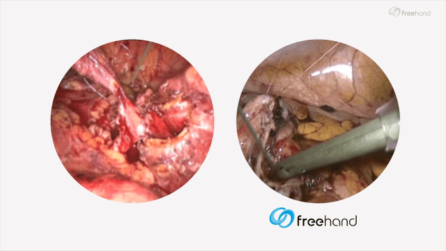 1-mastering-your-vision.png Comparison of handheld vs robotic view through laparoscope during surgery