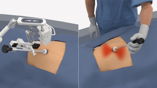 8-improves-patient-outcomes.png comparison of robotic vs handheld laparoscopy highlighting the dragging effect